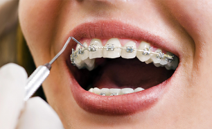 Sorriso Perfeito com Aparelho Dentário Completo! Consulta de Avaliação, Estudo de Ortodontia e Moldes no Porto!