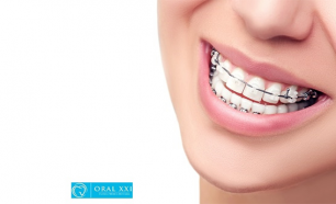 Sorriso Perfeito! Aparelho Dentário Mini-Estético com 4 Consultas de Acompanhamento ou Kit de Branqueamento!